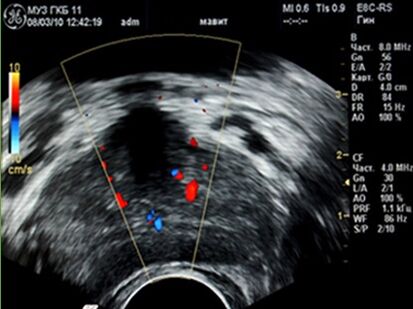 Ultrasound shows inflammation in the prostate