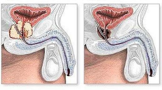 Before and after the treatment of chronic prostatitis