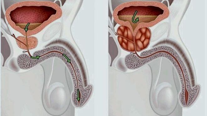 the prostate is healthy and becomes inflamed with prostatitis