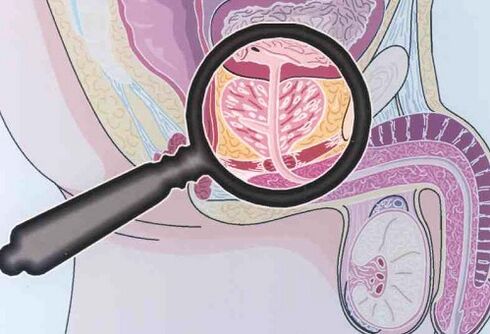 prostatic hypertrophy with prostatitis