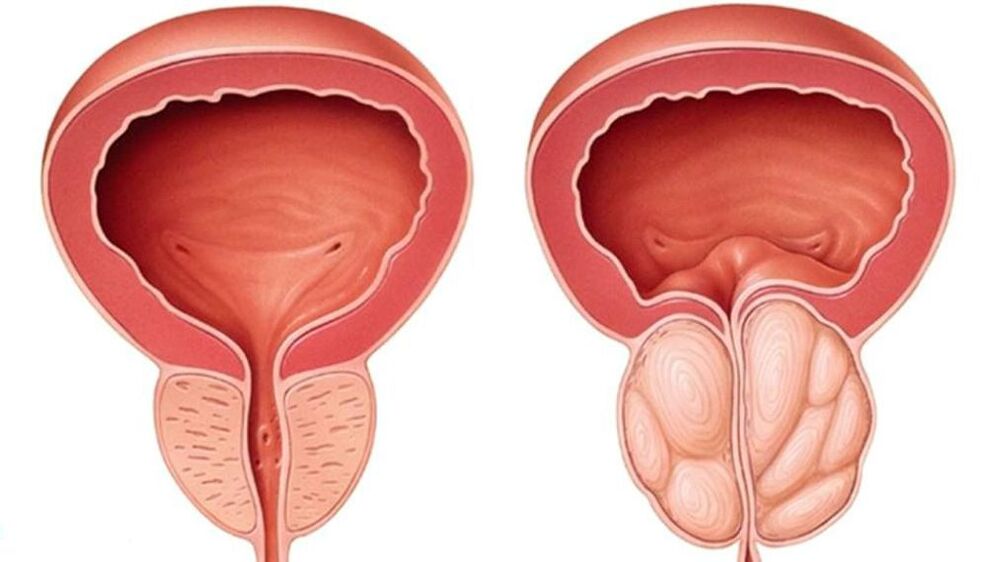 Normal and enlarged prostate