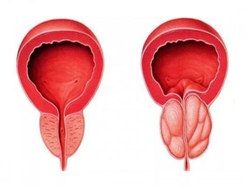 Healthy prostate and inflammation