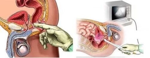 Prostatitis diagnostic tool